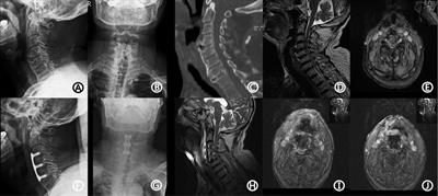 Delayed postoperative spinal epidural hematoma after anterior cervical discectomy and fusion: A case report